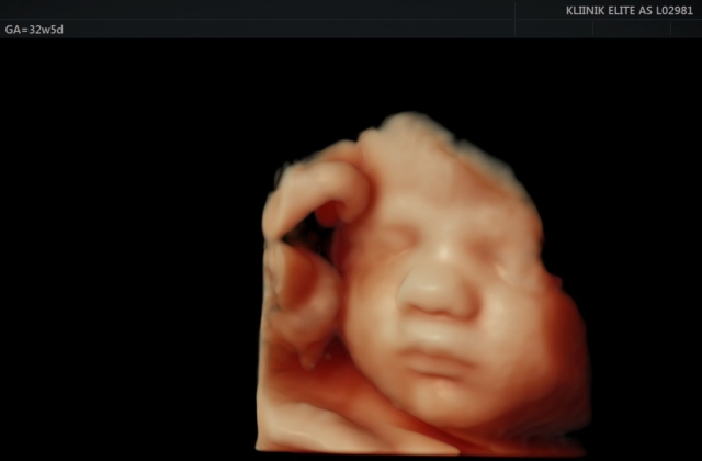 Elite Kliinikus 4D ultraheli pilt beebi näost 32. nädala 5. päeval.